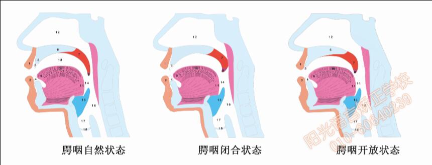 腭裂修复术示意图